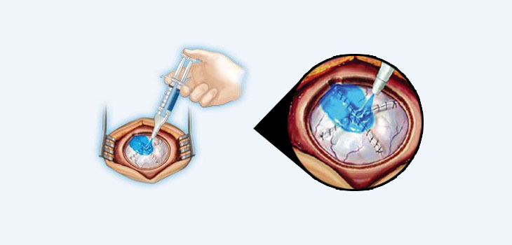 Integra LifeSciences Buys Covidien’s DuraSeal