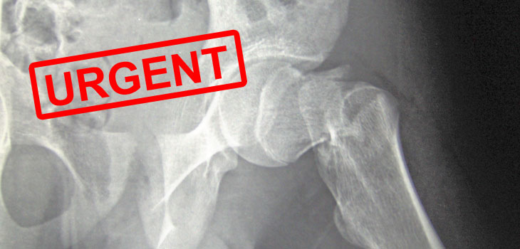 Hip Fracture? Get to the OR ASAP