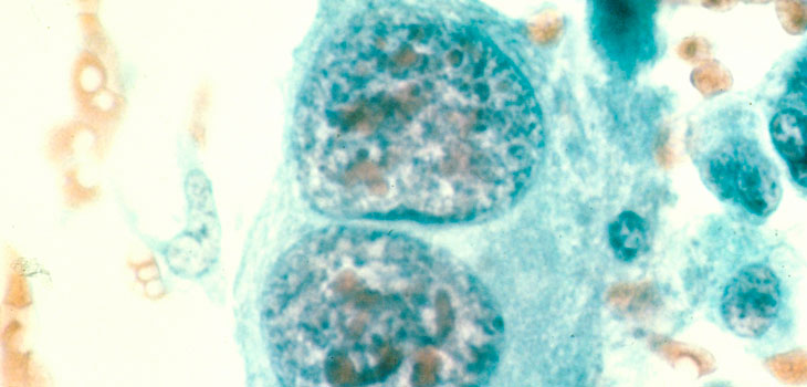 IOF Publishes Osteoporosis/Cancer Paper