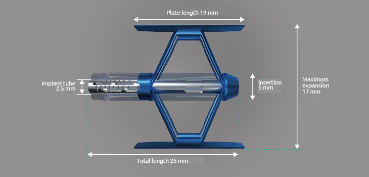 SpineJack Aces Trial, Reports Vexim
