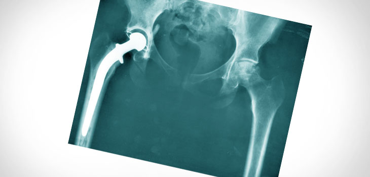Joint Arthroplasty Readmissions Top 5%