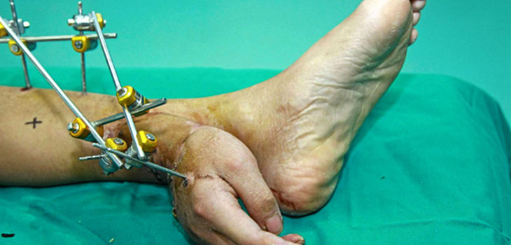In This Case: Don’t Walk It “Off”