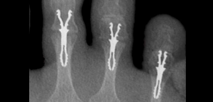 Hammertoe Device Gains FDA Clearance