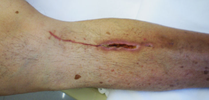 NPWT With/Without Irrigation Trumps Control Therapy