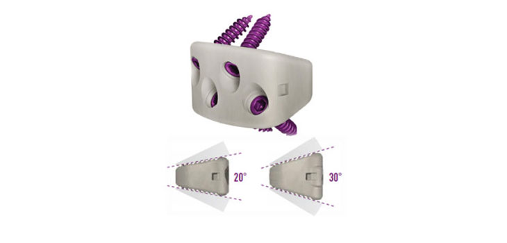 NuVasive Launches Sagittal Plane Imbalance Solution in U.S.
