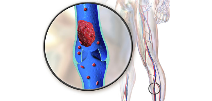 Aussies 3x More Vulnerable to DVT