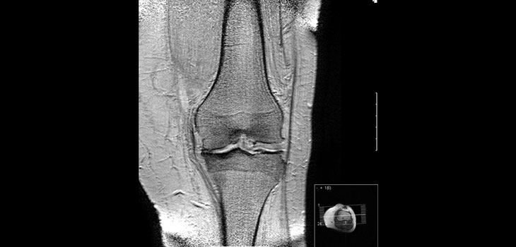 Surgeons Overly Conservative? // Popping, Clicking Knees May be OK // and More!