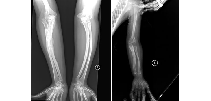 Stem Cell Injections Ease Osteogenesis-Imperfecta Ravage