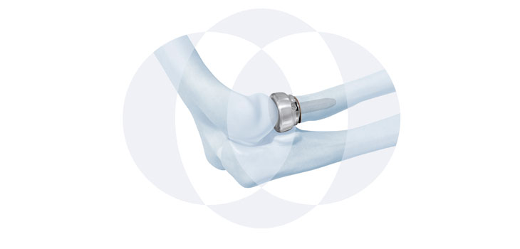 DePuy Synthes Trauma’s New Radial Head System