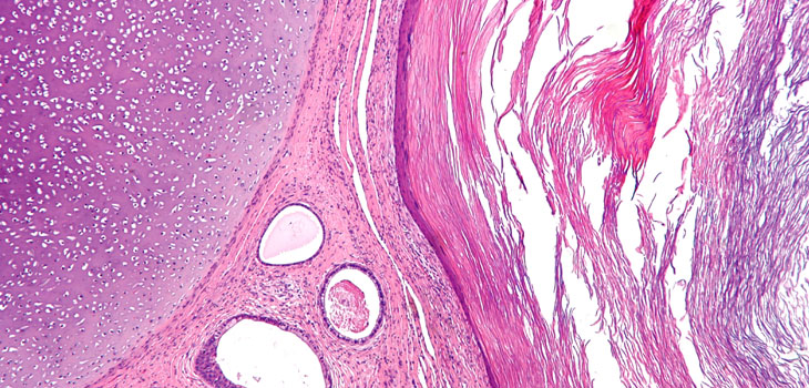 UCLA Breakthrough Announced for Stem-Cell Cartilage
