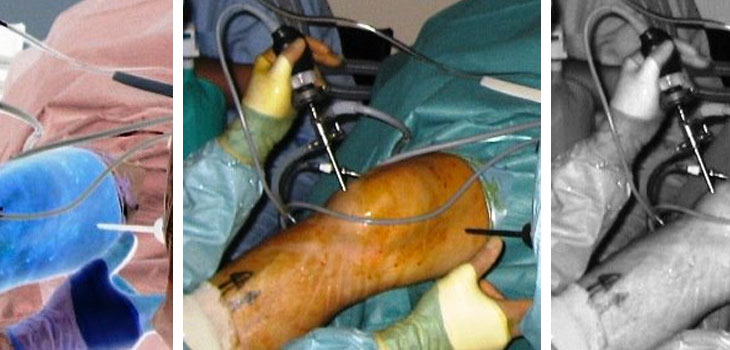 Sham Surgery as Good as Partial Meniscectomy