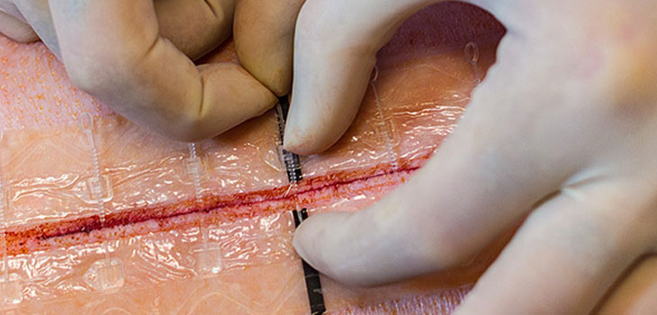 ZipLine Zaps Sutures, Gains Funding