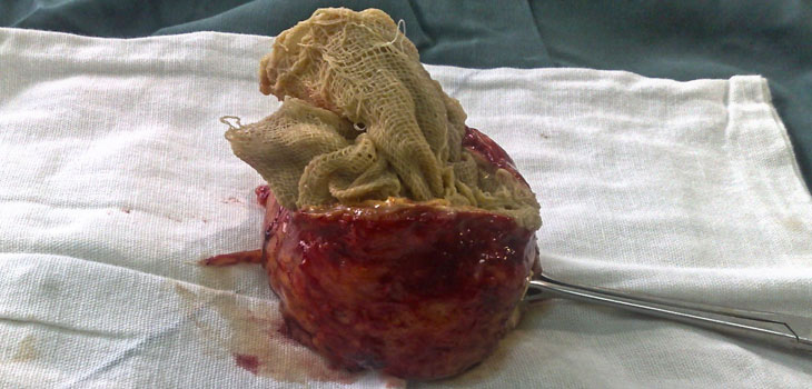 Stryker Invests $120 Million to Remember the Sponge