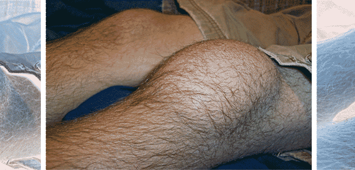 Arthroscopy Knee Surgery Complications Up