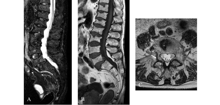 Study: Romosozumab Significantly Increases BMD