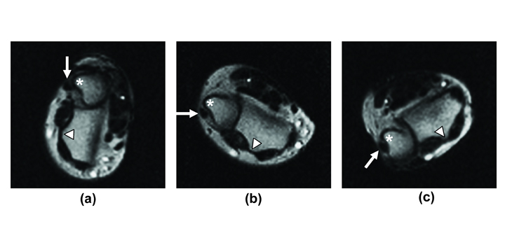 Moving MRI Useful in Diagnosis