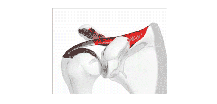 Patch Offers Rapid Rotator Cuff Repair