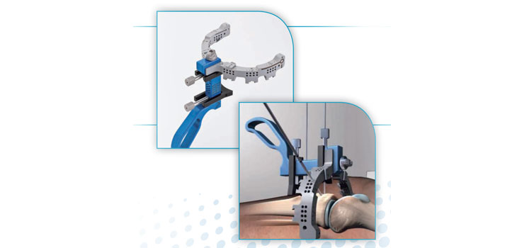 Five Patents for Zimmer Joint Preservation Procedure