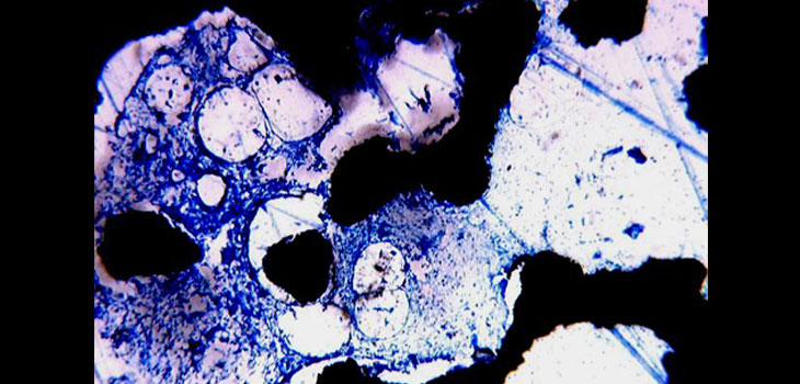 New Study: 95% Meniscal Allograft Survival Rate! // ACDF Non-Fusion Rate Higher Than Expected // Are Antibiotic-Containing Balls the Future of Infection Prevention?