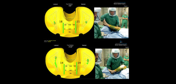 VERASENSE Removes TKA Guesswork