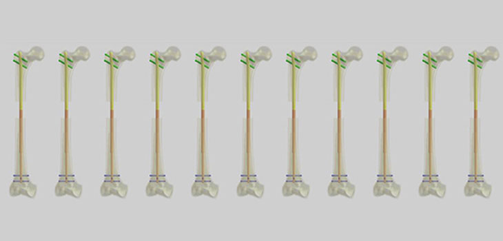 Limb Lengthening System Gets Marketing Clearance