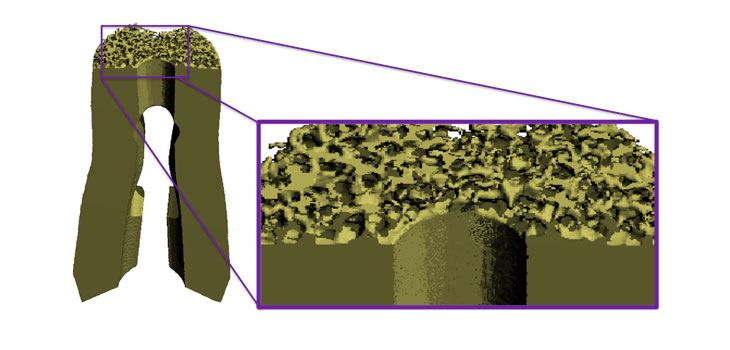 MedShape’s New Technology: PEEK Scoria