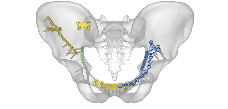 Acumed Launches Pelvic Plating System