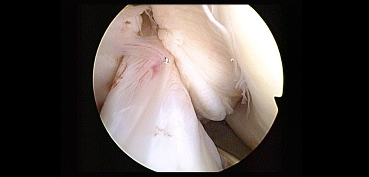Young ACL Sufferers: Increased Risk for Later Knee Arthritis?
