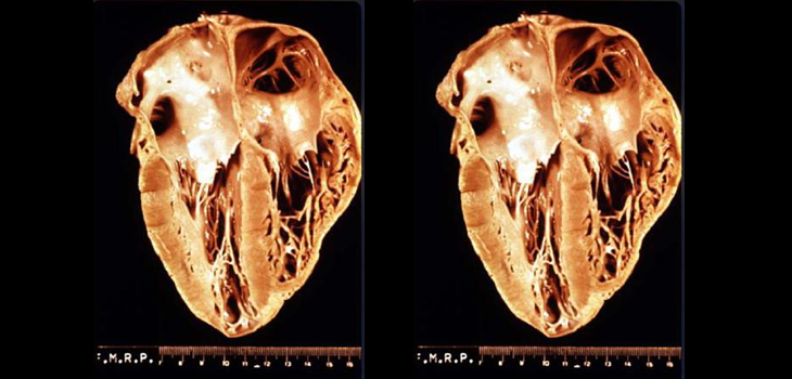 TJR Protects Against Cardiovascular Disease