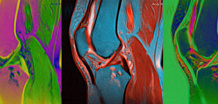 Glucosamine Does Not Lessen Knee Cartilage Deterioration