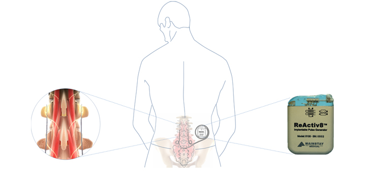 New Device Attacks Lower Back Pain