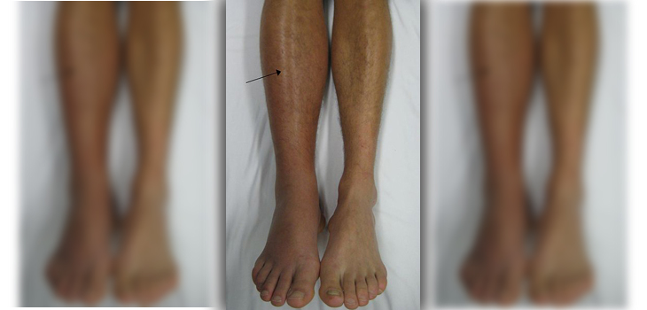 Statins+Conventional Therapies Reduce VTE Risk