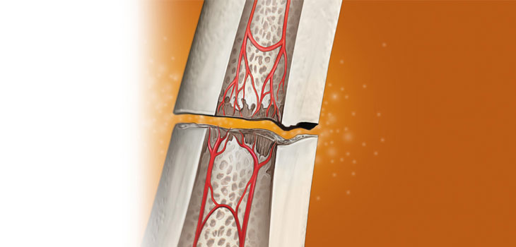 Exogen Bone Healing: Performance Guaranteed!