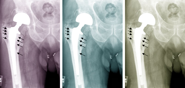 HRT Cuts Revisions after Joint Surgery