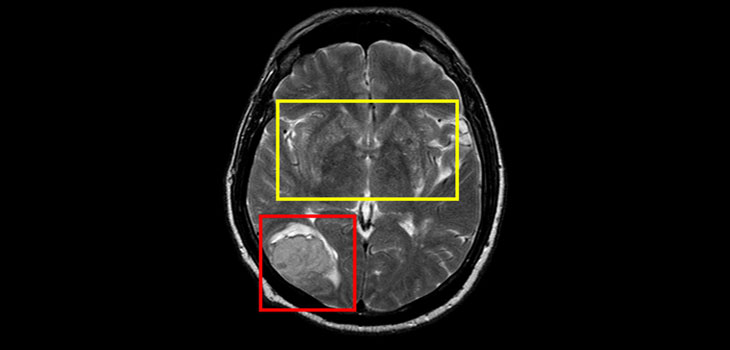 Adult Stem Cells Aide Stroke Recovery