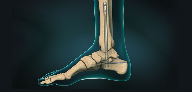 MedShape: Positive Results for DynaNail