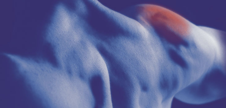 Collagen Scaffold Cleared For Shoulder Repair