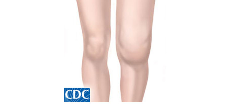 Study: Sprifermin Reduces Total Cartilage Thickness Loss
