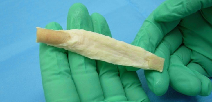 CE Mark for Aperion Biologic’s ACL Reconstruction Device