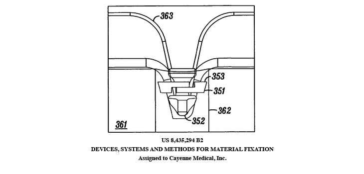 Cayenne Medical Claims MedShape Violates Fixation Patent