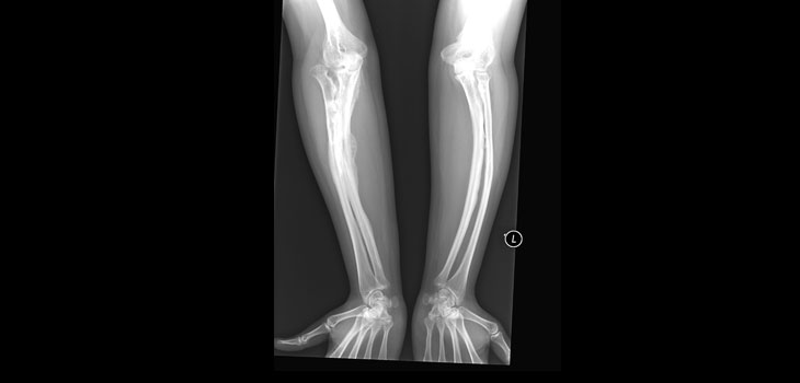 New Treatment for Brittle Bone Disease