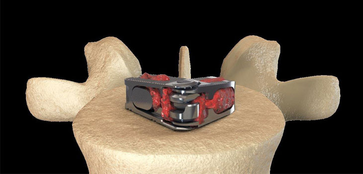 Expanding Orthopedics’ Cage Presented at ISASS