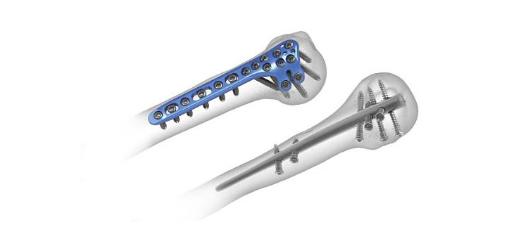 Acumed Upgrades Humerus Fracture Device