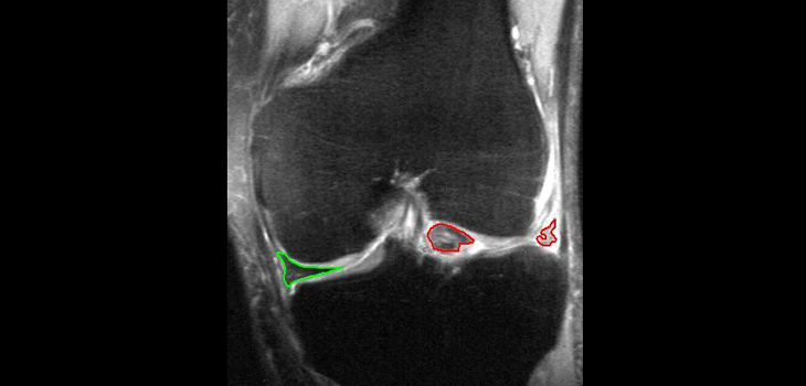 Tiny Trial Increases Knee Cartilage 41%