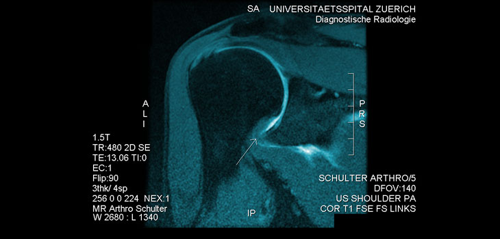Frozen Shoulder Treatment Study Launched