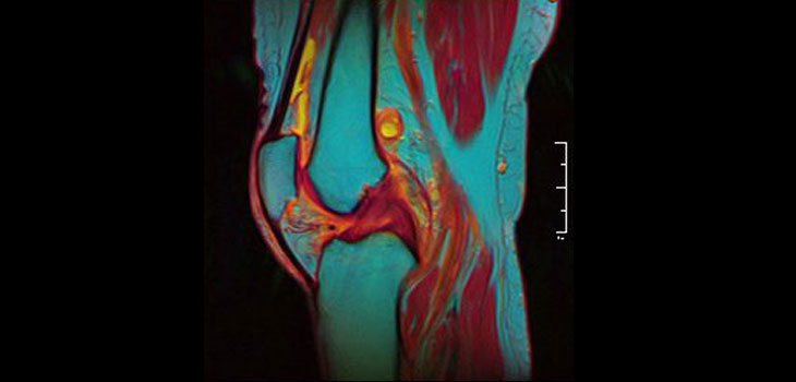 Trial Tests Regeneration of ACL Tissue