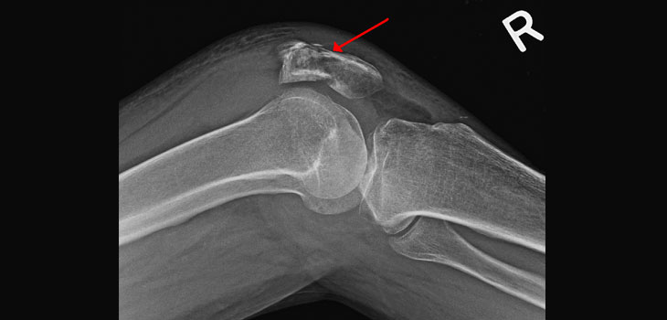 Predicting Fractures After Patients Stop Bisphosphonate