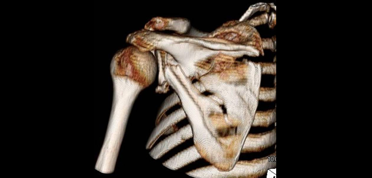 Minnesota’s Peter Cole, M.D. — King of Scapula Repair