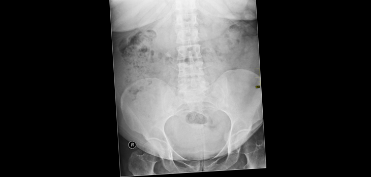 Obesity a Hip Replacement Threat