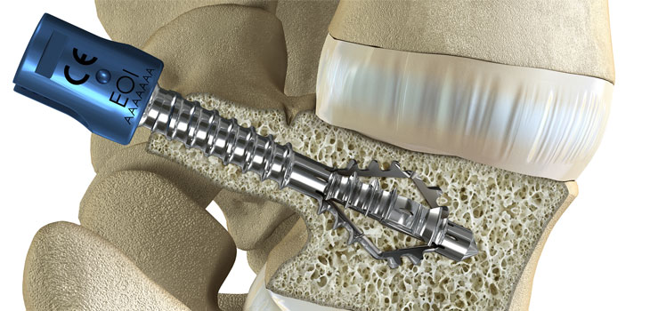 Expanding Orthopedics Awarded Chinese Patent